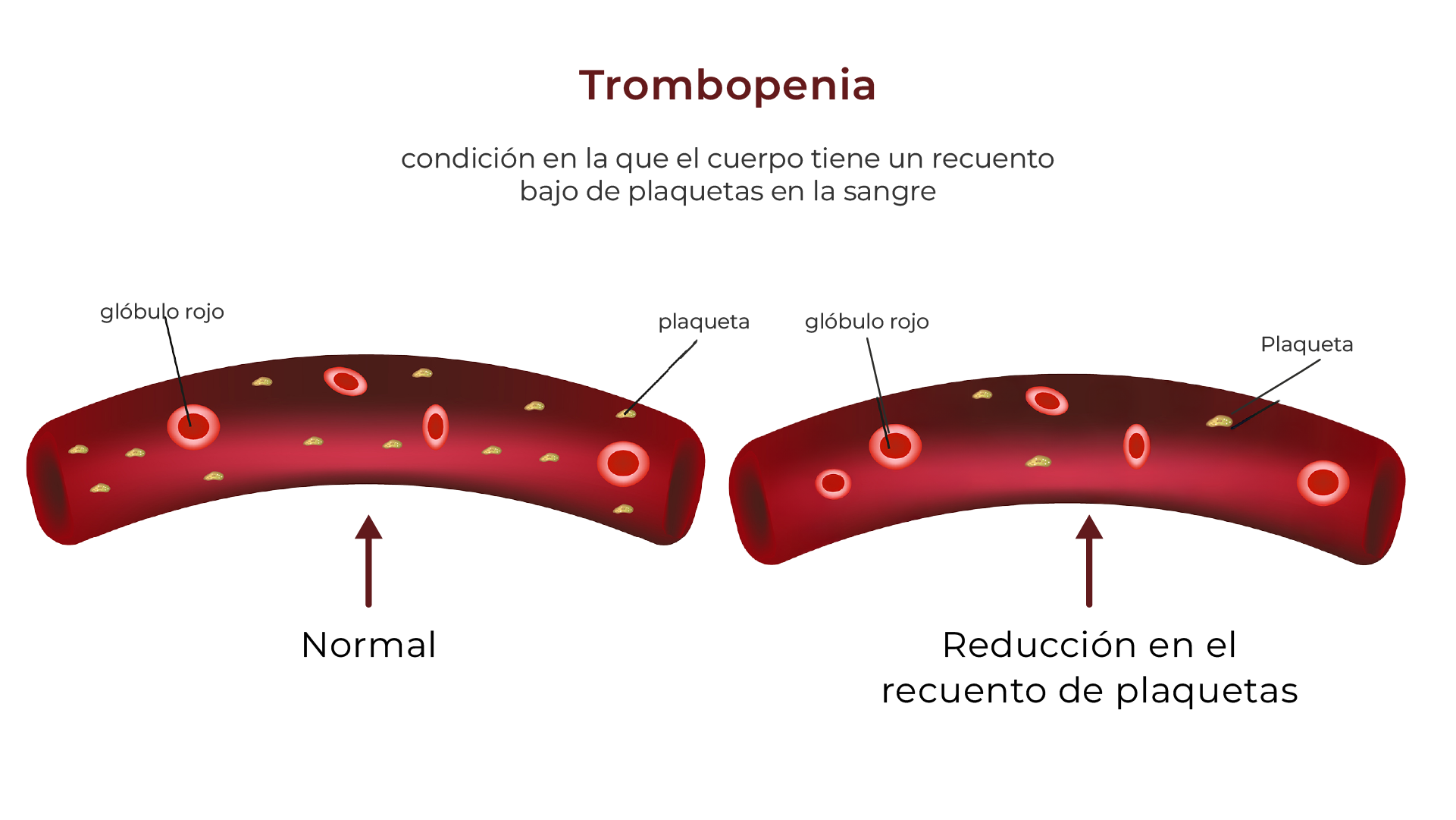 Trombocitopenia (plaquetas bajas)