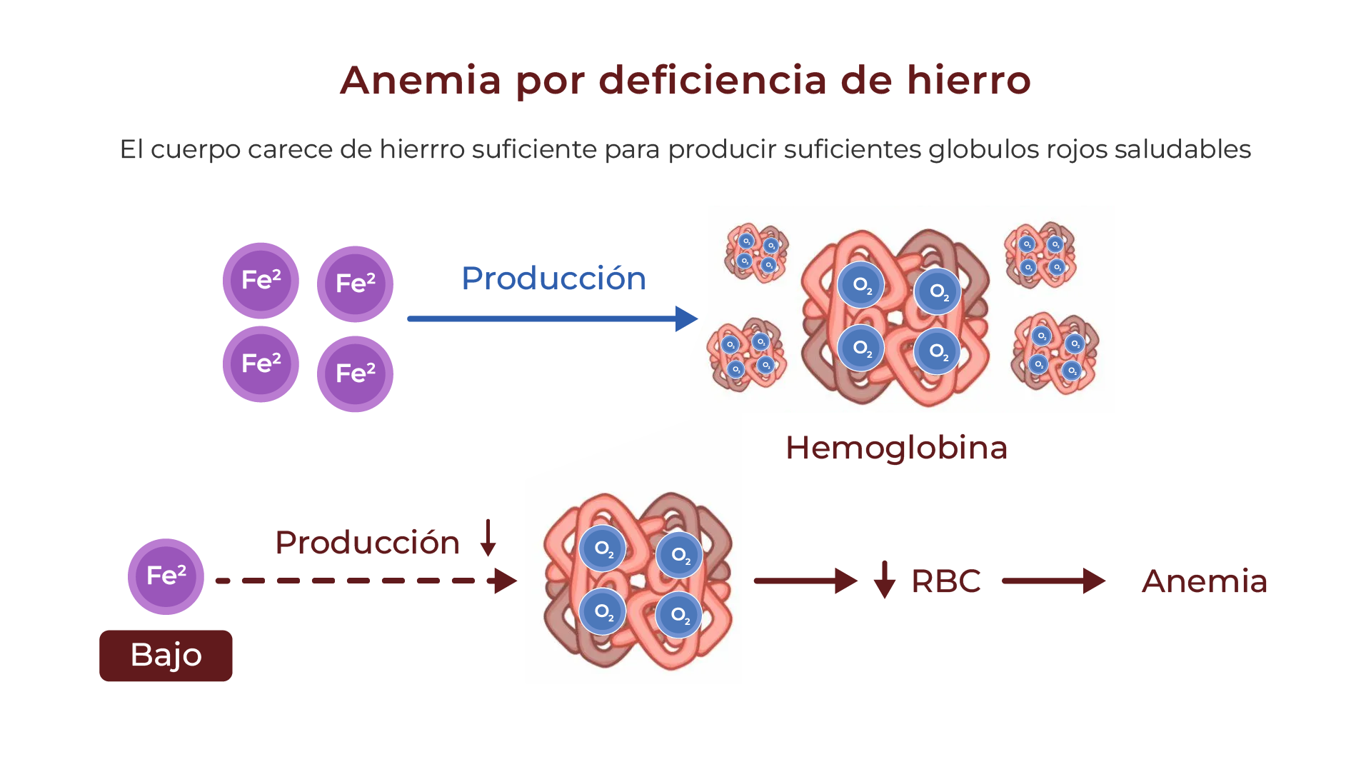 Anemia por deficiencia de hierro - Glóbulos rojos normales vs. deficientes en hierro