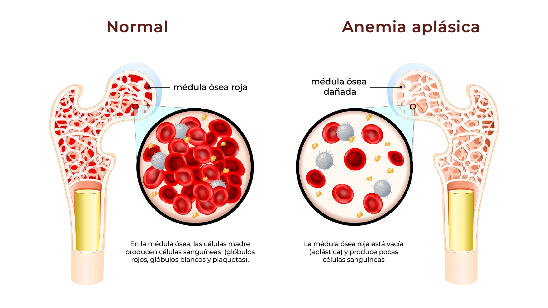 Comparación entre médula ósea normal y anemia aplásica