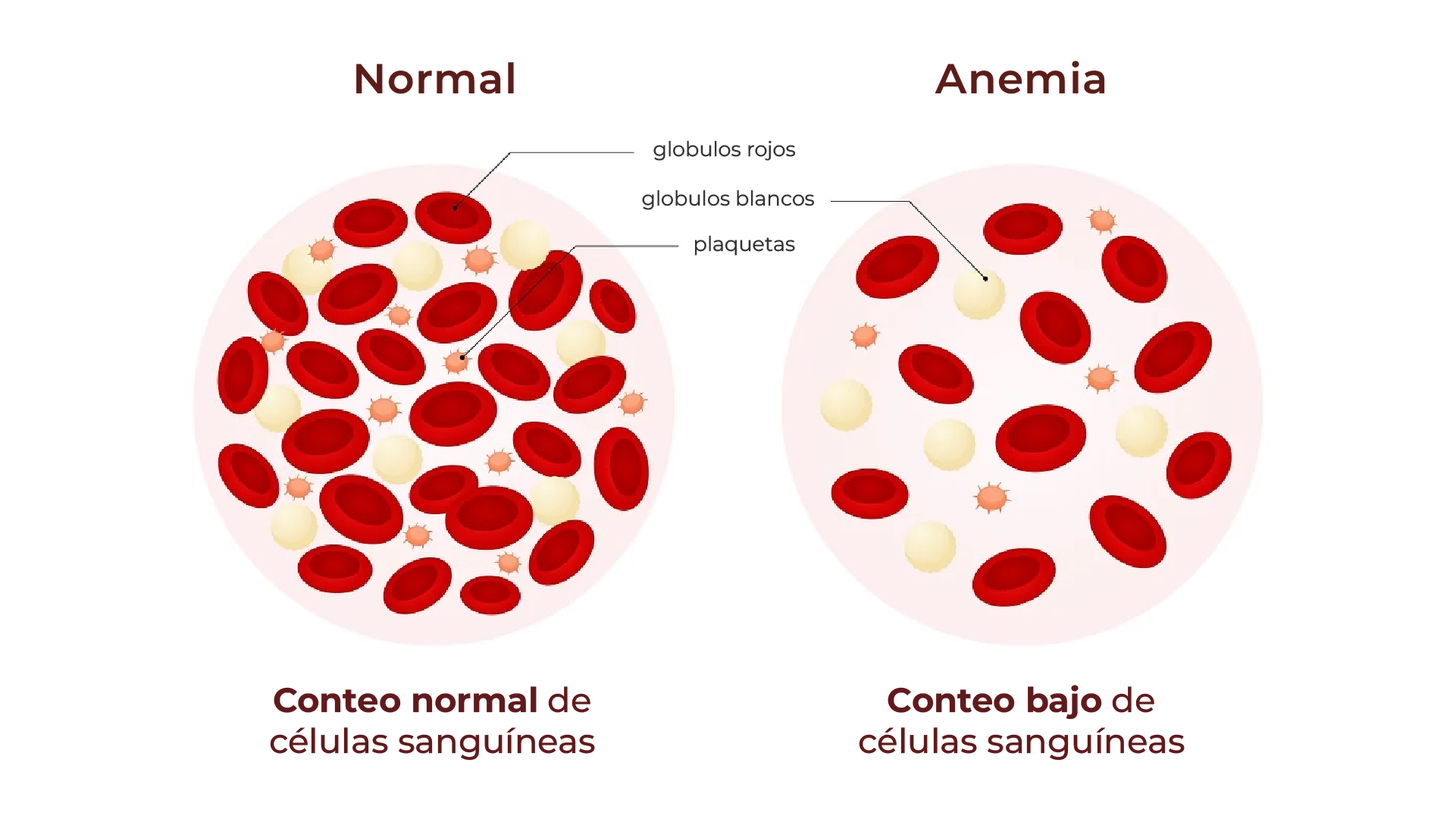 Comparación de conteo normal vs. anemia