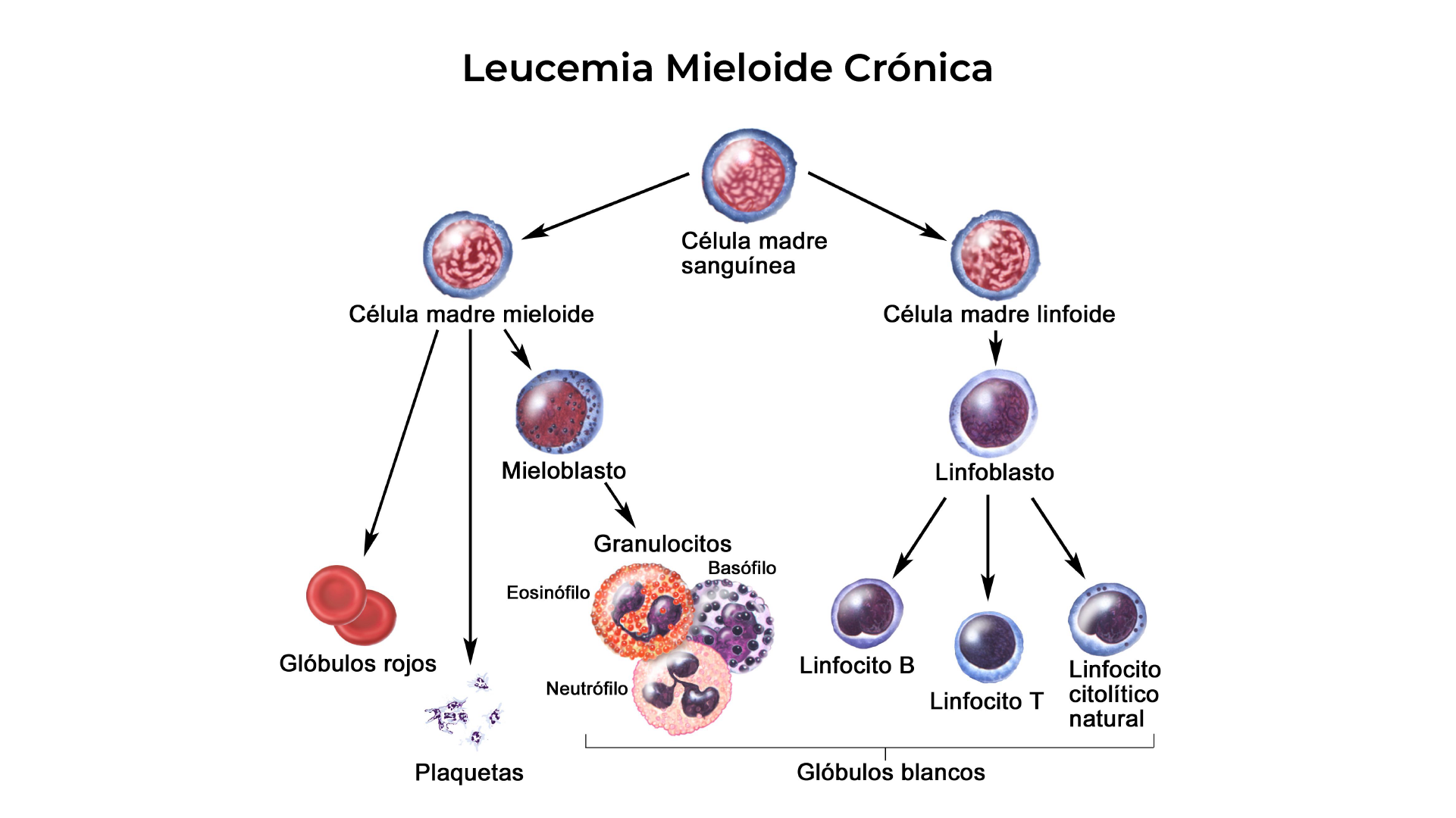 Comparación de conteo normal vs. anemia