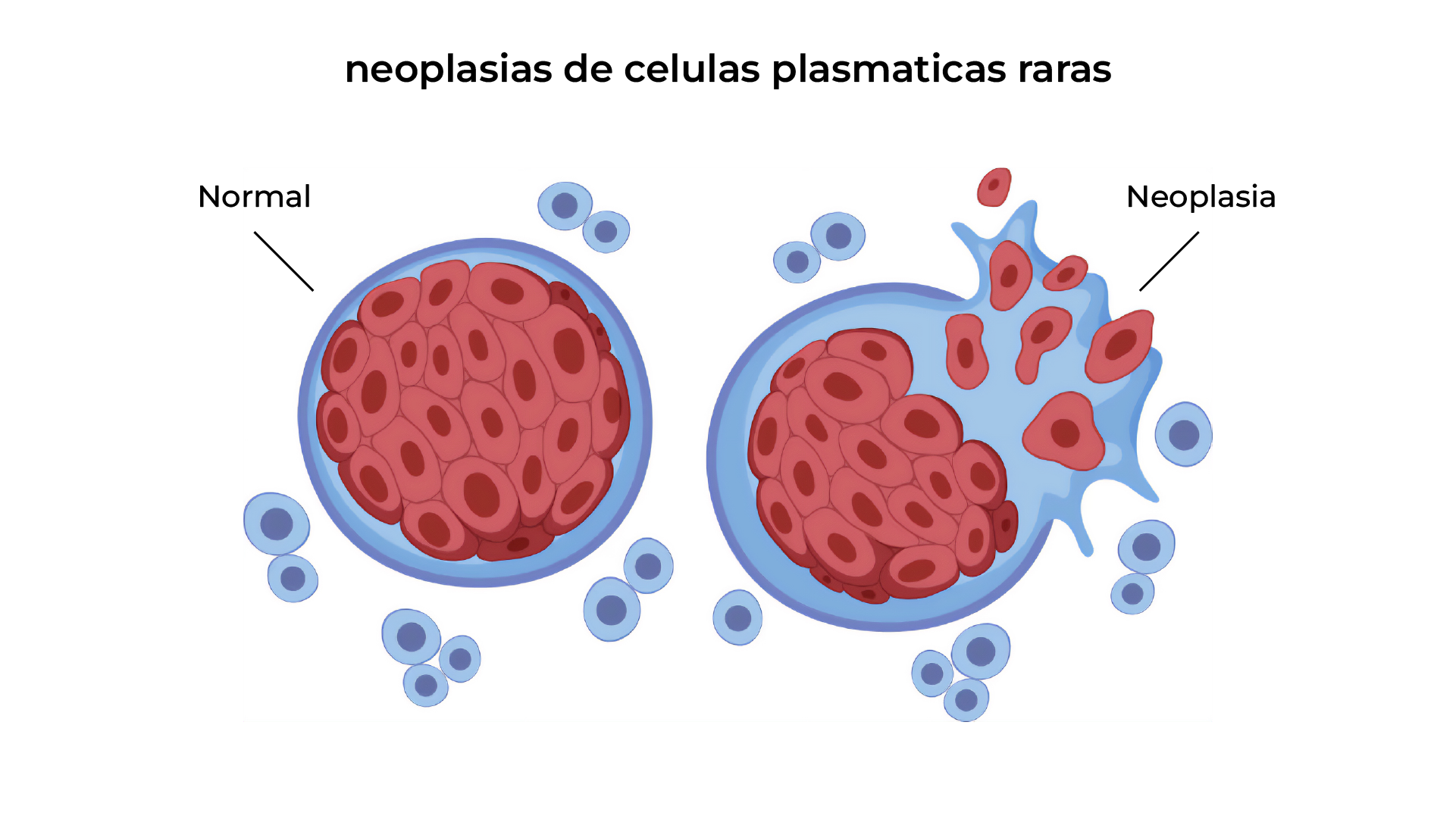 Comparación de conteo normal vs. anemia