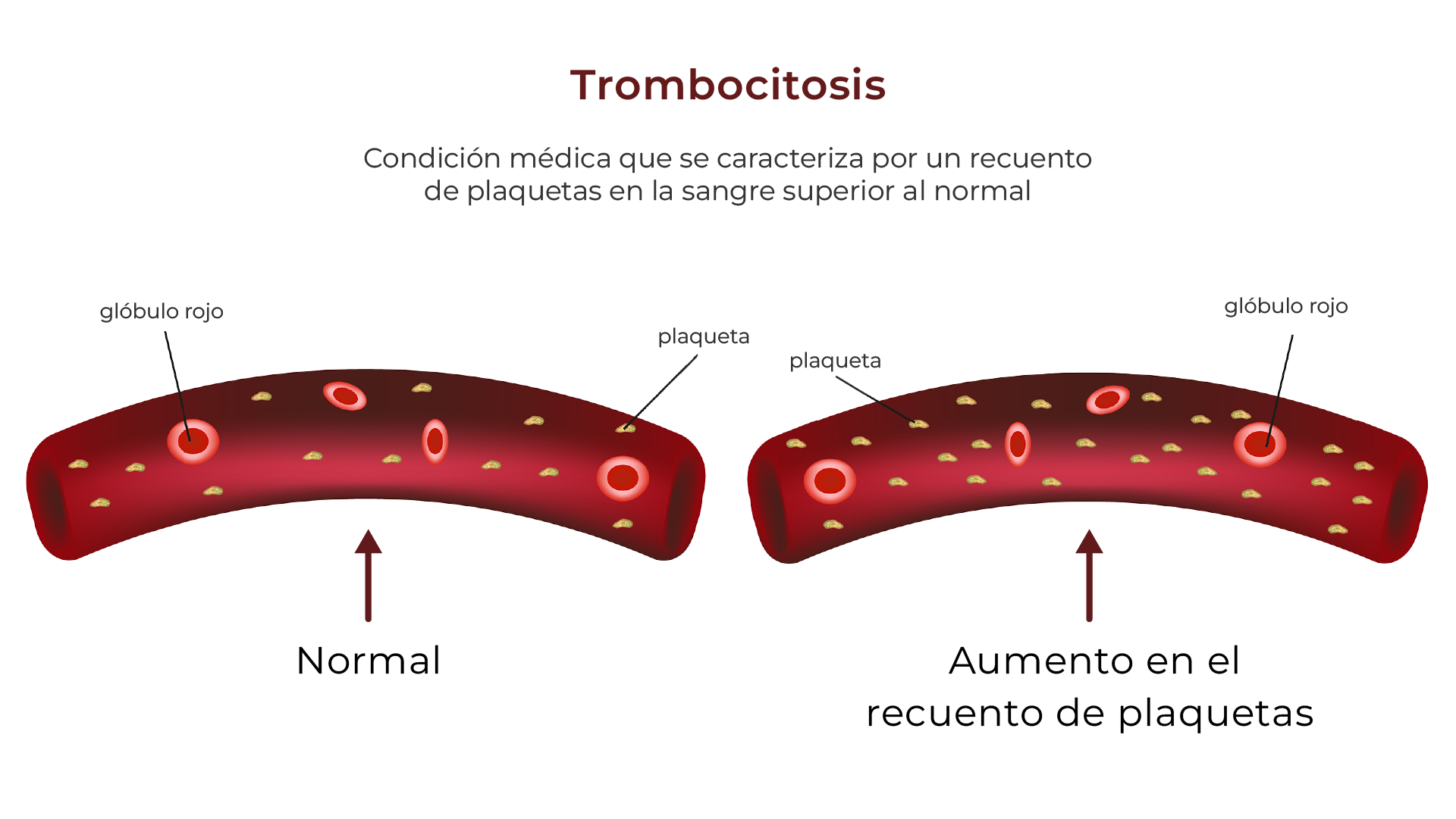 Trombocitosis (plaquetas altas)