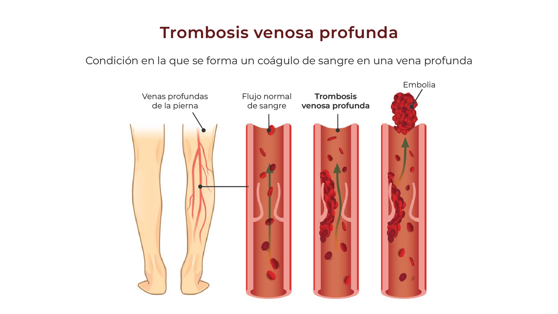 Trombosis venosa profunda