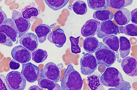 Leucemia mieloide aguda (LMA)