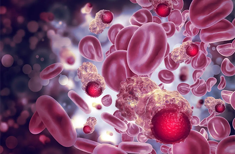 Leucemia mieloide crónica (LMC)