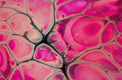 Neoplasias de células plasmáticas raras